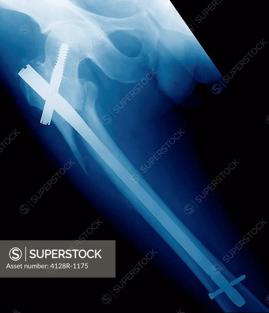Pinned broken leg, X_ray