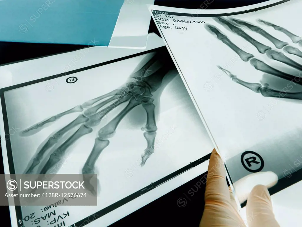 X-rays of hands.