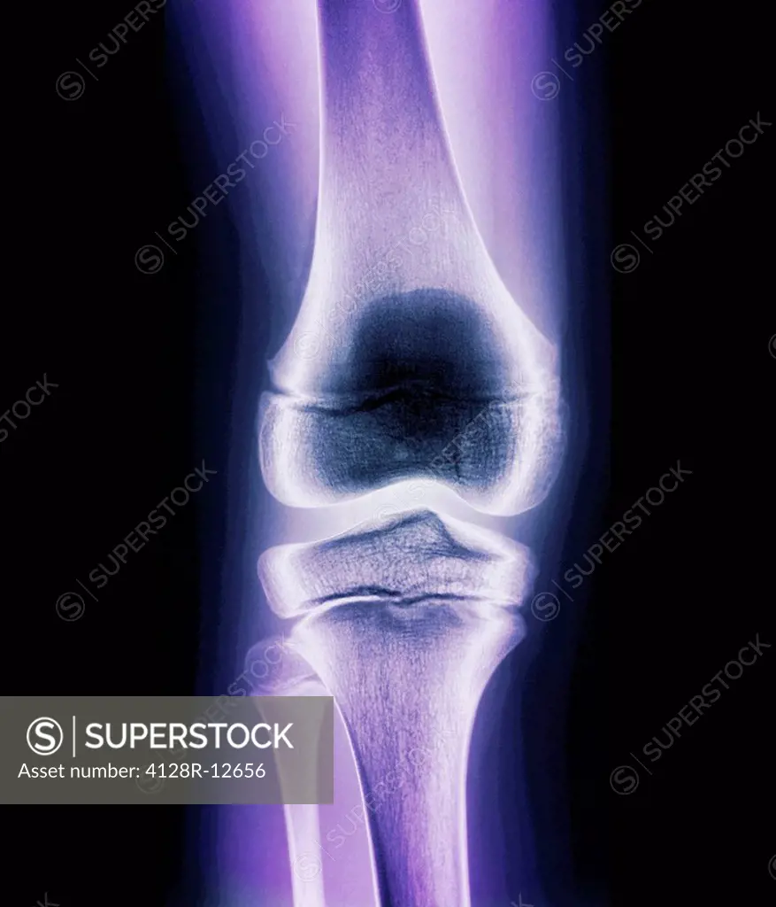 Normal child´s knee. Frontal coloured X_ray of the knee of a 10 year old child.