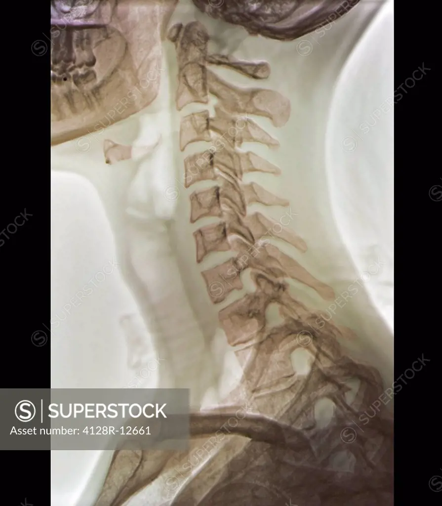 Normal neck. Coloured X_ray of the cervical spine of a 27 year old.