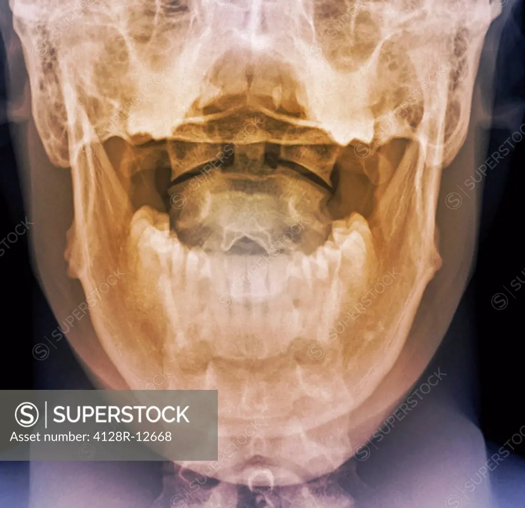 Normal neck. Coloured frontal X_ray of the joint between the skull and the neck.