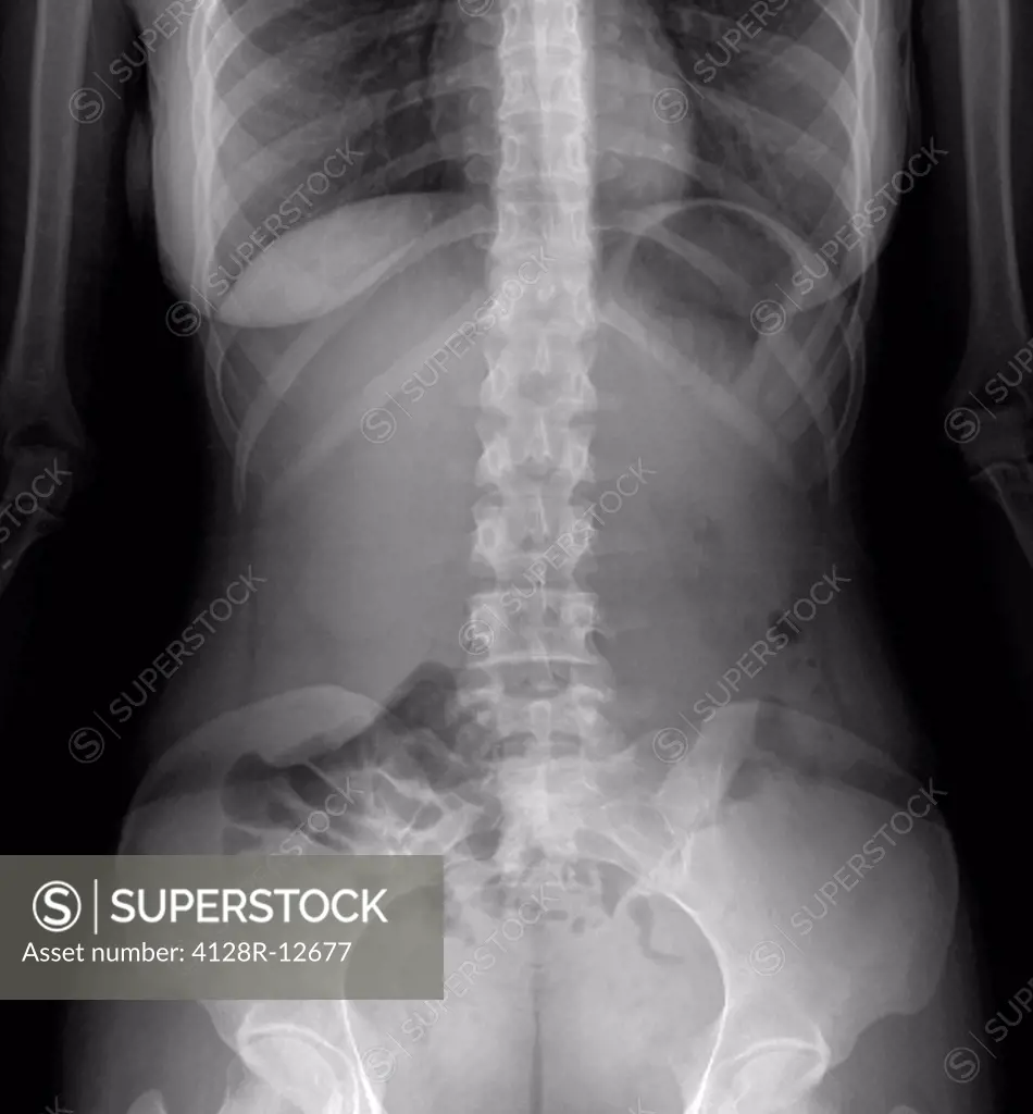 Normal abdomen. X_ray of the abdomen of a 20 year old female.