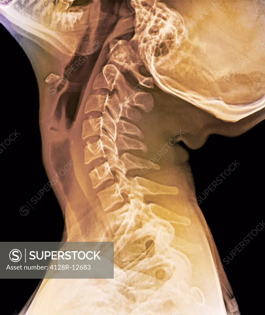Normal extended neck. Coloured X_ray of the extended cervical spine of a 20 year old female.