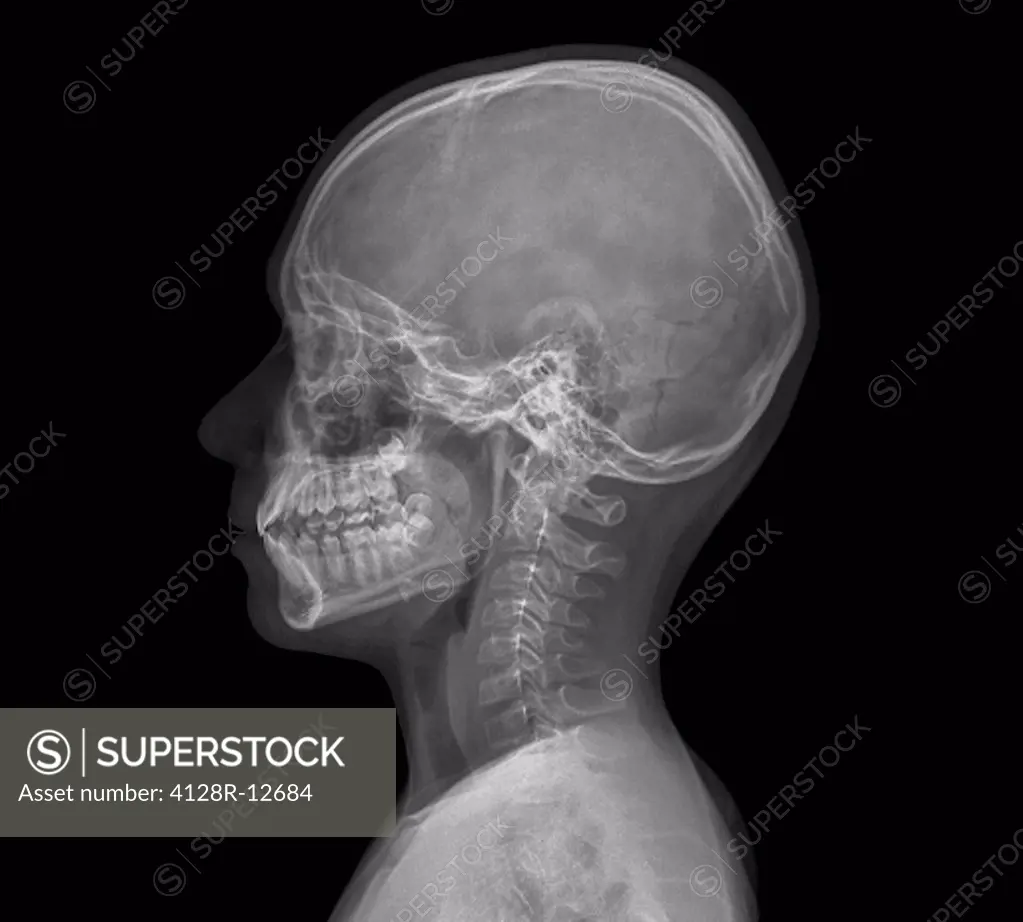 Normal child´s head. X_ray of the head of a 13 year old.