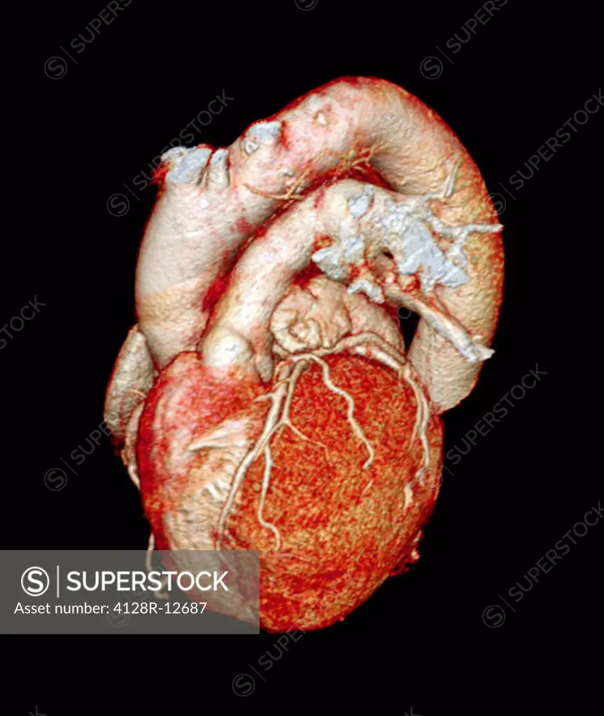 Normal heart. 3D computed tomography CT scan of a healthy heart from a 58 year old male.