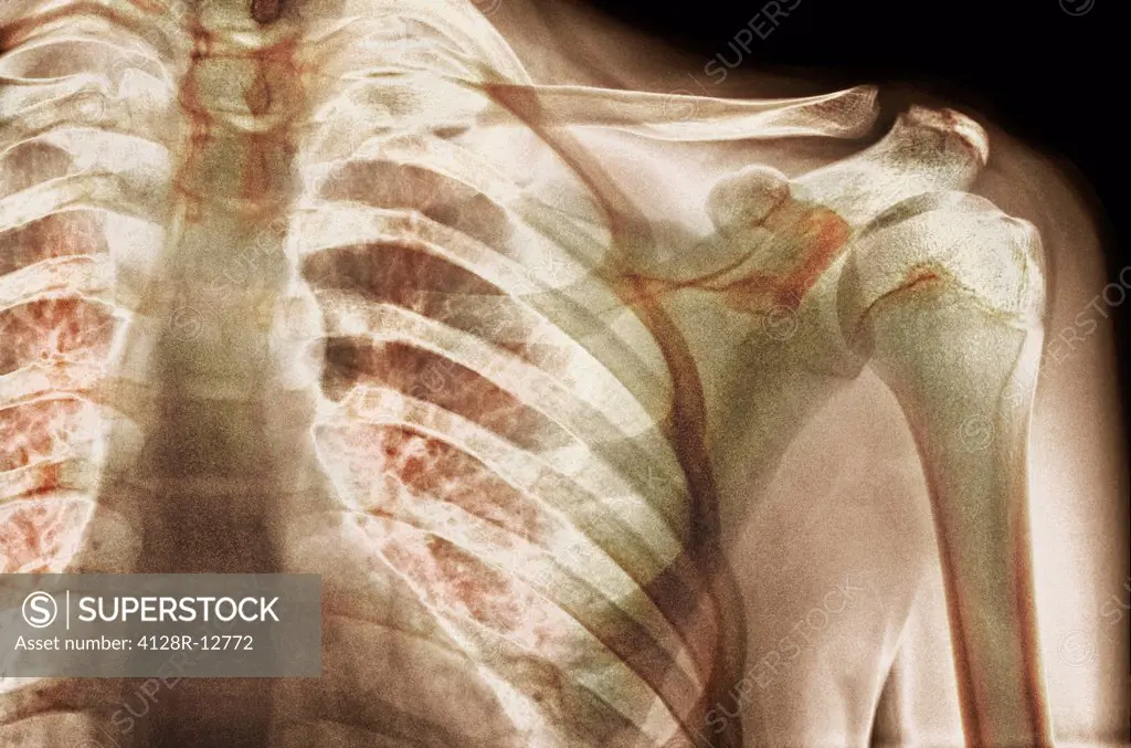 Normal shoulder. Coloured X_ray of the shoulder of a 19 year old man.