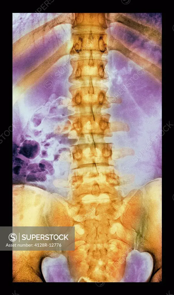 Normal spine. Coloured X_ray of the spine of a 24 year old man.