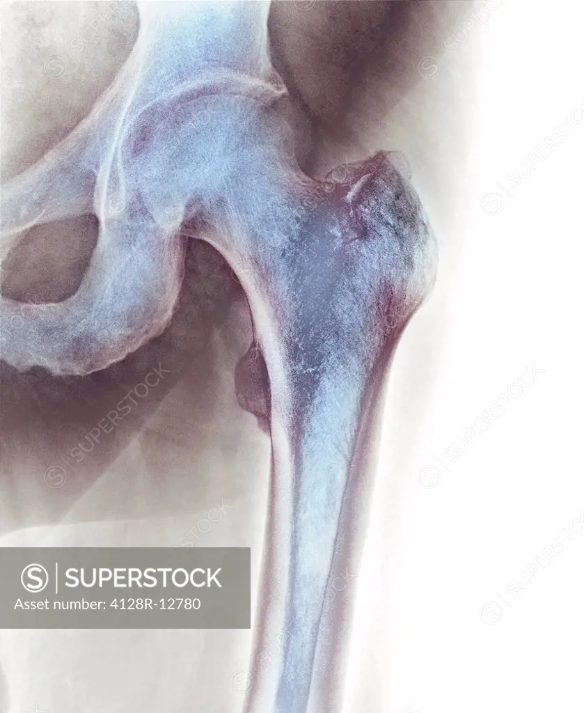 Normal hip. Coloured X_ray of the hip of a 90 year old man.