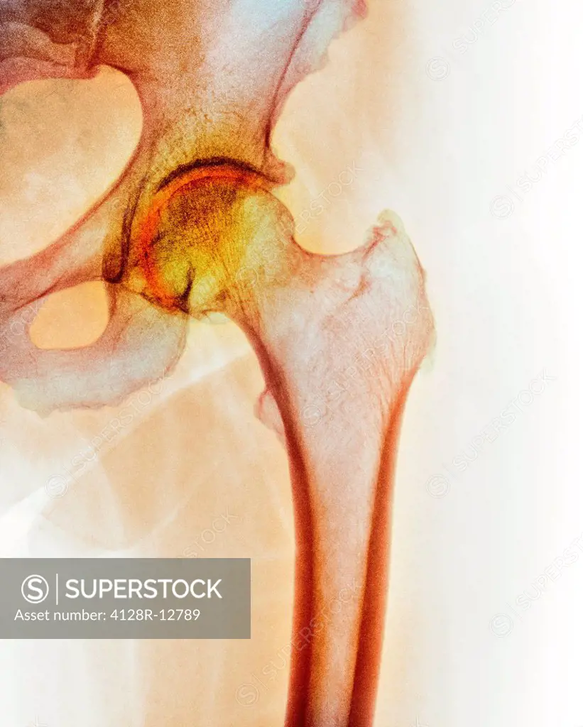 Arthritis of the hip. Coloured X_ray of an arthritic hip.