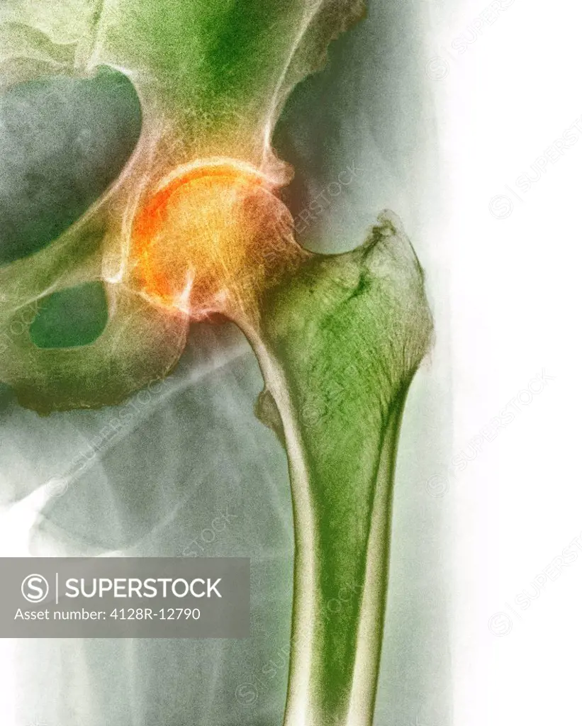 Arthritis of the hip. Coloured X_ray of an arthritic hip.