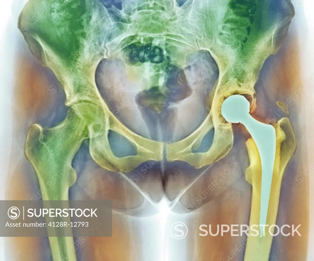 Loosened hip replacement. Coloured X_ray of a loosened total hip replacement of the left hip right of a female. The right hip left is showing signs of...