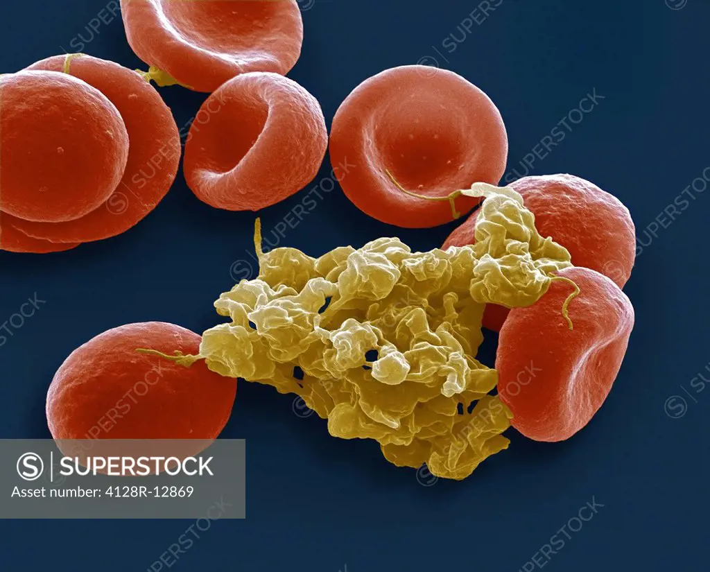 Blood cells. Coloured scanning electron micrograph SEM of red blood cells and an aggregate of platelets yellow. Magnification: x4000 when printed at 1...