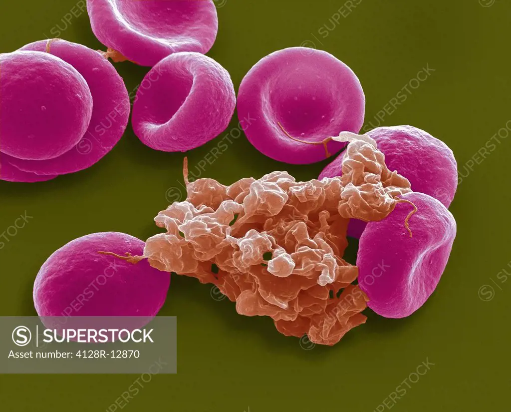 Blood cells. Coloured scanning electron micrograph SEM of red blood cells pink and an aggregate of platelets red. Magnification: x4000 when printed at...