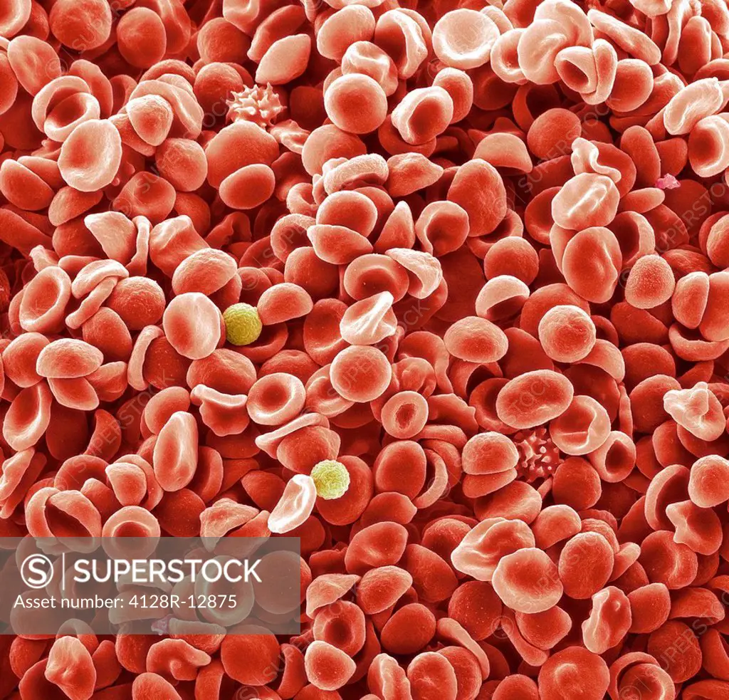 Human blood cells. Coloured scanning electron micrograph SEM of normal human blood. The majority of the cells are red blood cells, but white blood cel...