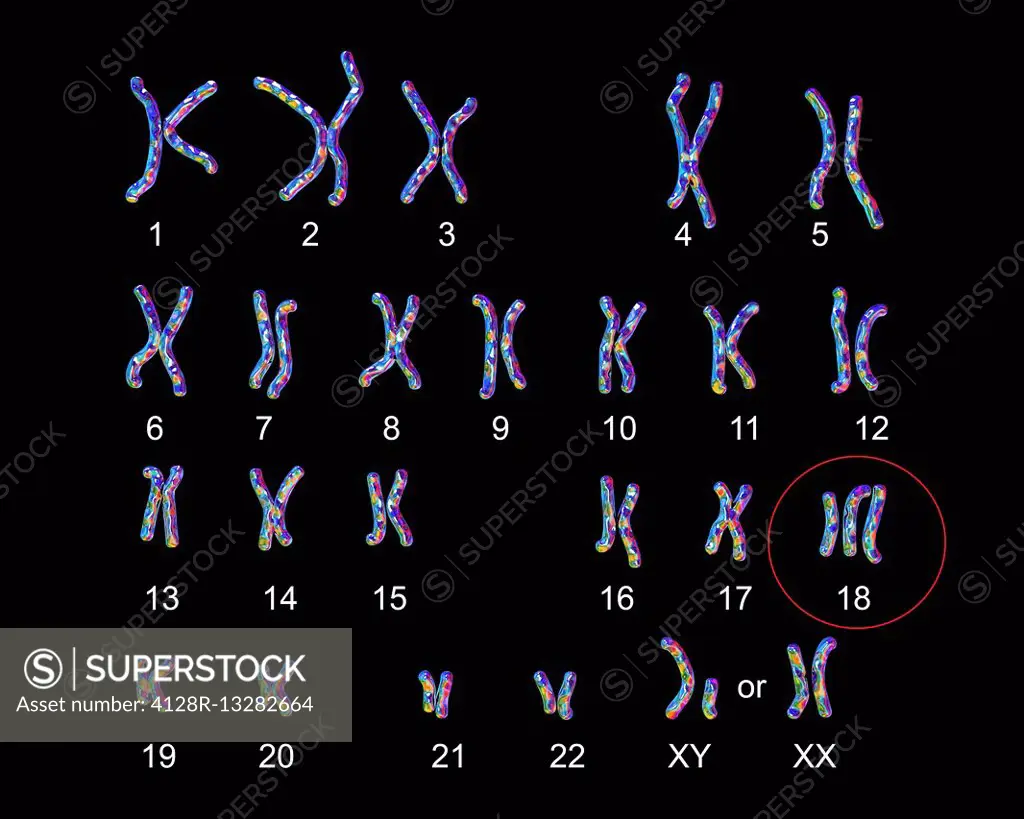 Karyotype showing the arrangement of chromosomes in a male or female with Edward's syndrome (trisomy-18). Edward's syndrome is caused by a chromosomal...