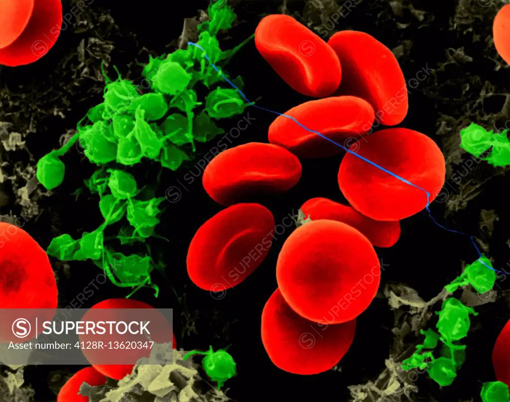 Human red blood cells, activated platelets, and fibrin threads, composite coloured scanning electron micrograph (SEM). Human red blood cells (RBCs), o...