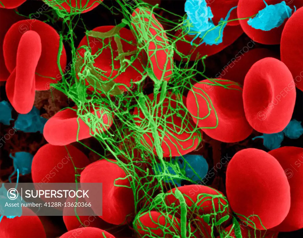 Human red blood cells and activated platelets trapped in a fibrin blood clot, composite coloured scanning electron micrograph (SEM). Platelets in the ...