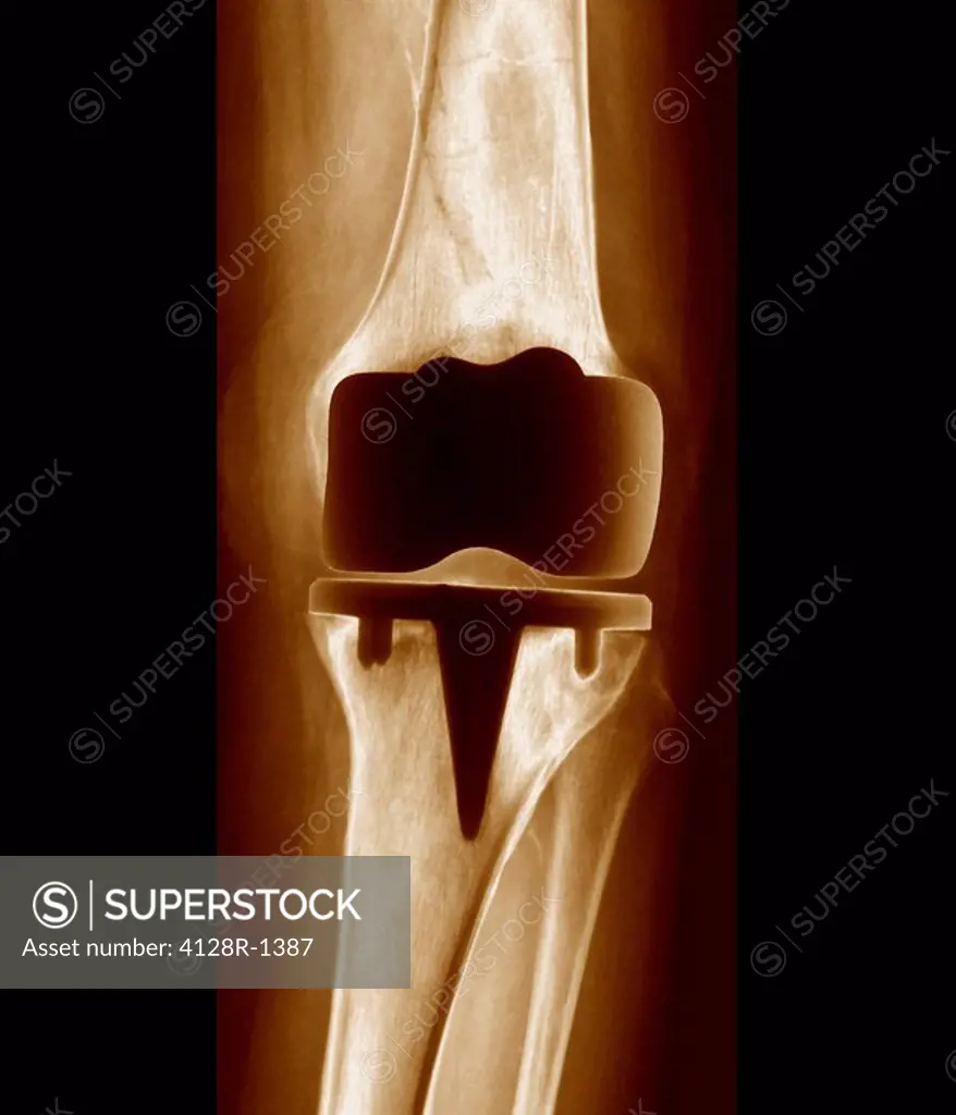 Prosthetic knee joint, X_ray