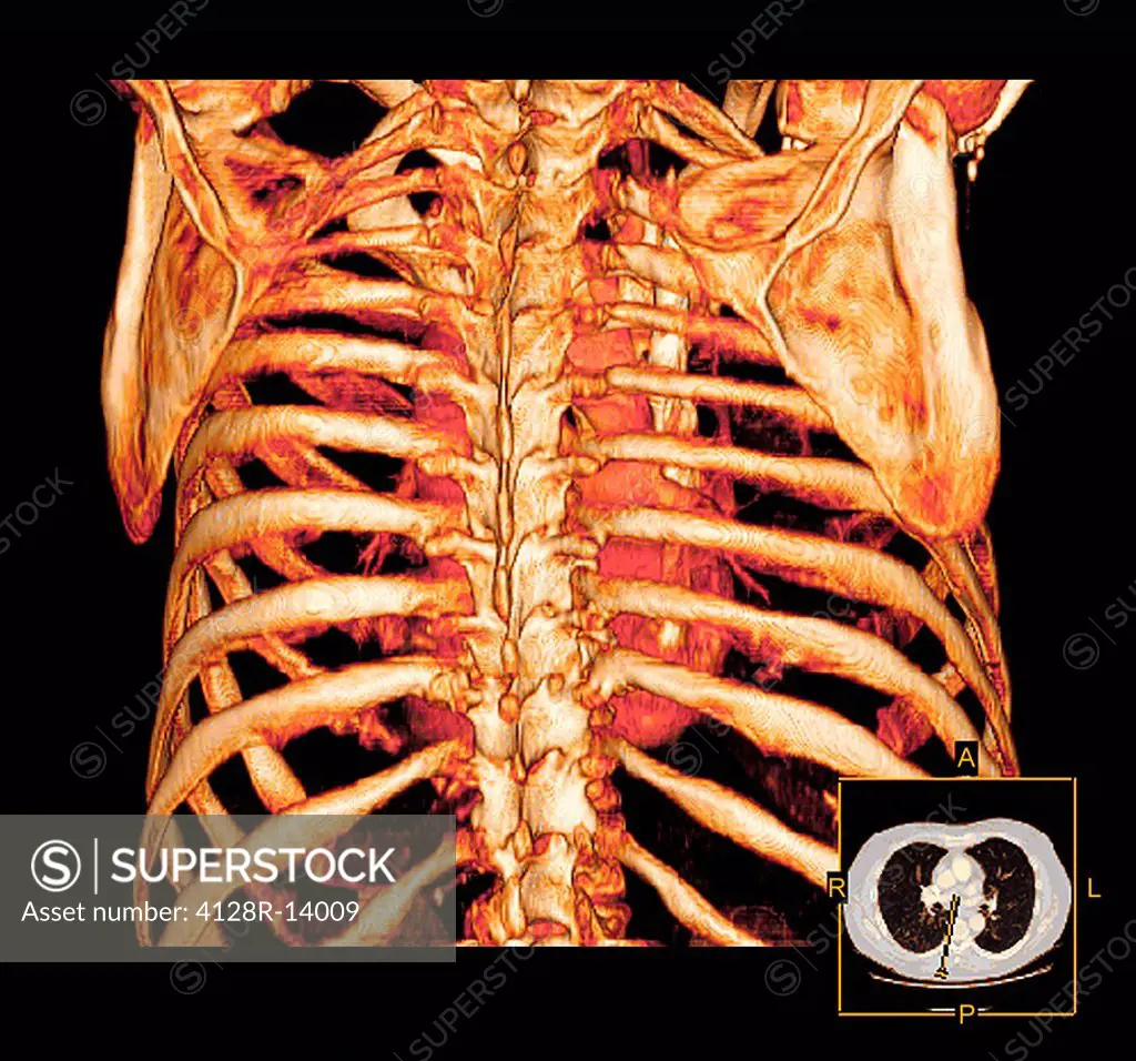 Rib cage. Coloured three_dimensional computed tomography CT scan of a posterior view of a healthy rib cage and heart.