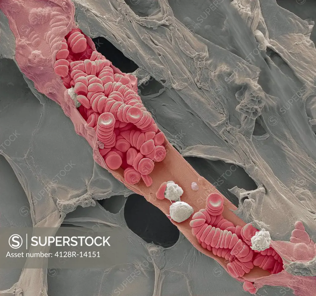 Ruptured venule. Coloured scanning electron micrograph SEM of a ruptured venule running through fatty tissue. Stacked red blood cells rouleaux formati...