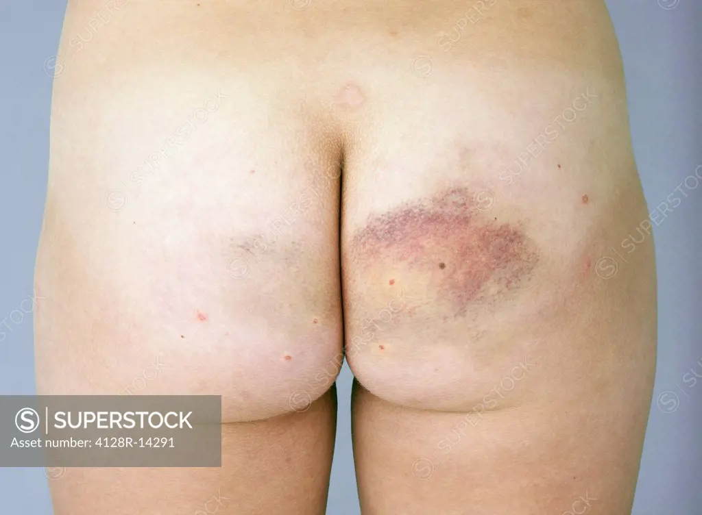 Bruised buttock.