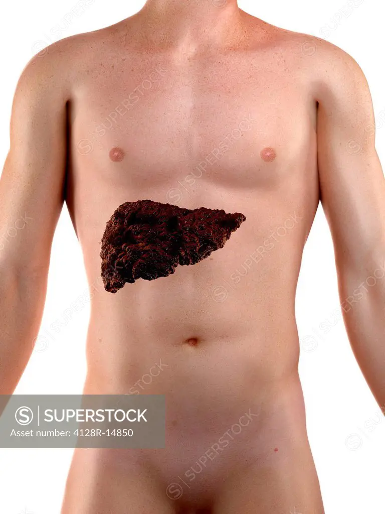Cirrhosis of the liver, computer artwork. Cirrhosis is a degenerative disease that leads to thickening of the liver tissue and loss of function.