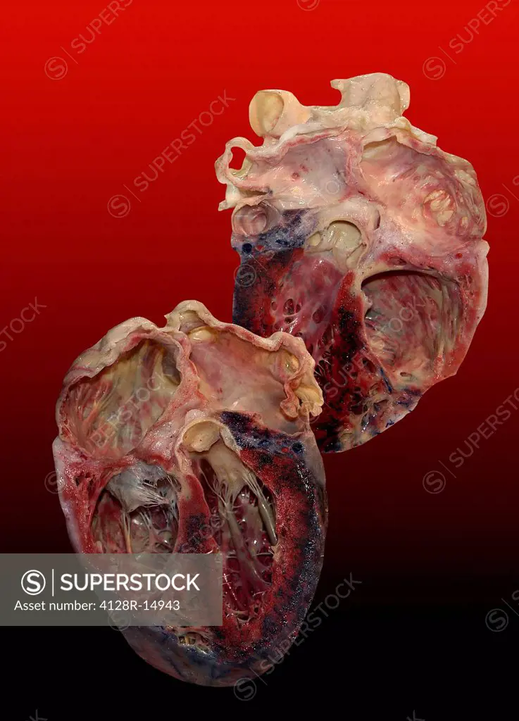 Dissected human heart.
