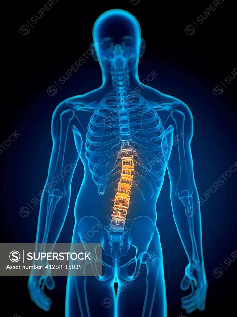 Scoliosis. Computer artwork of a man with a sideways curvature scoliosis of the spine.
