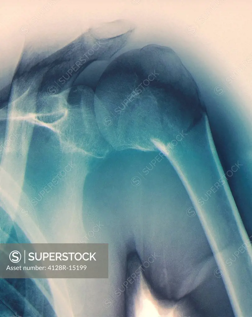 Broken shoulder. Coloured X_ray of the shoulder of a patient with a fracture in the neck of the humerus upper arm bone.