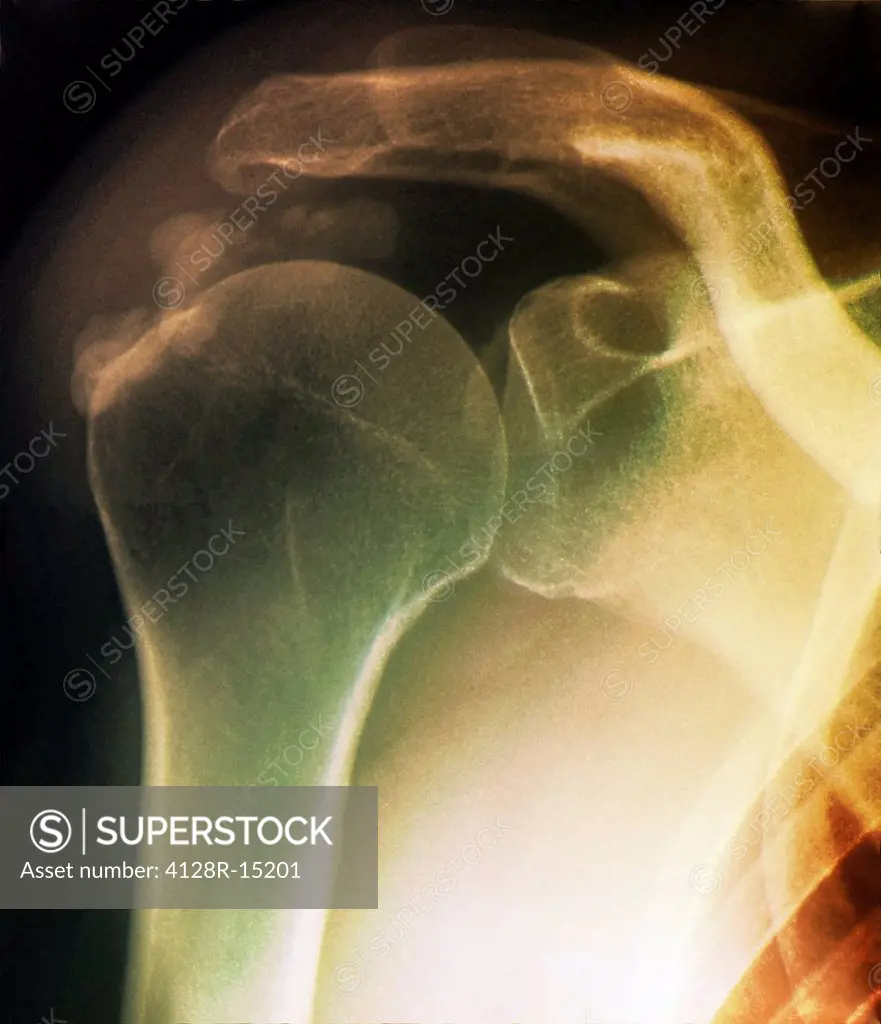 Tendinitis of the shoulder. Coloured X_ray of the shoulder of a patient showing calcification grainy patches around the rotator cuff tendon upper left...
