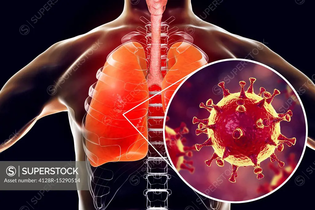MERS virus infection of lungs, conceptual illustration