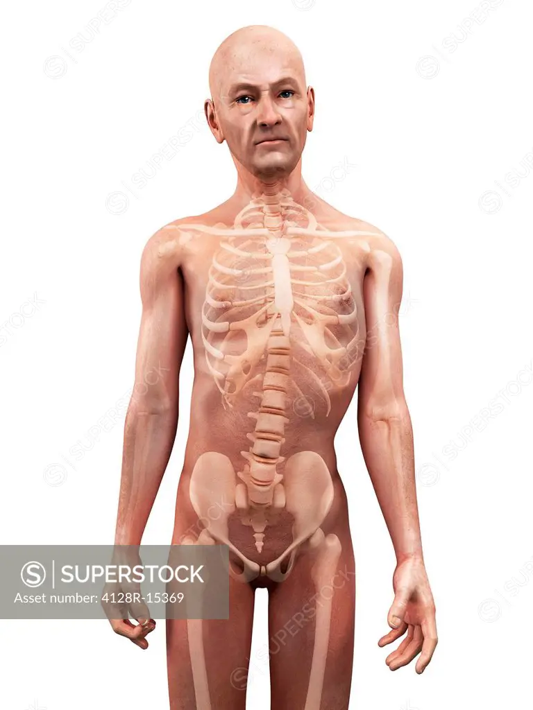 Scoliosis. Computer artwork of a senior man with a sideways curvature scoliosis of the spine.