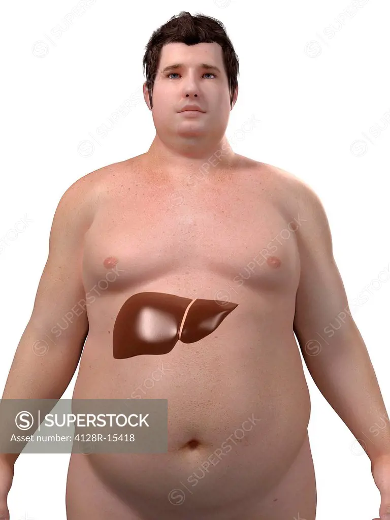 Obese man´s liver, computer artwork.