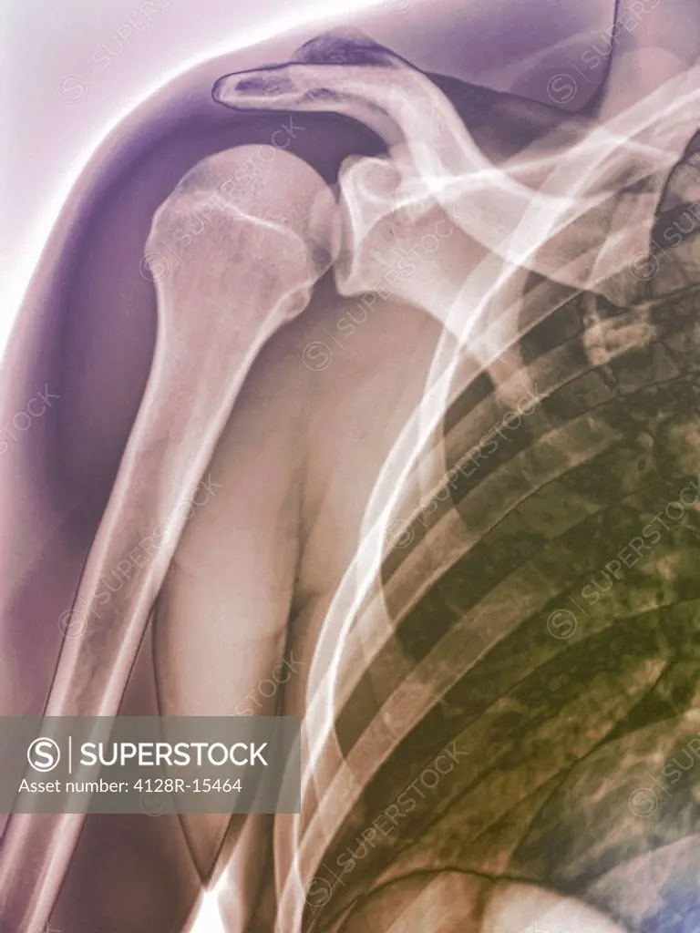 Normal shoulder. Coloured X_ray of the healthy right shoulder of a 28 year old patient.