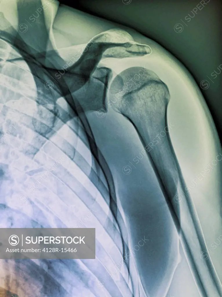 Normal shoulder. Coloured X_ray of the healthy left shoulder of a 28 year old patient.