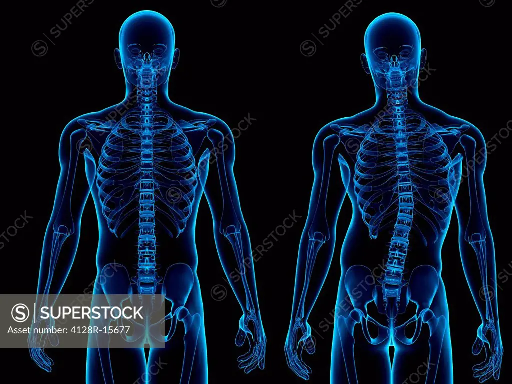 Scoliosis. Computer artwork of a healthy spine left and a spine with a sideways curvature scoliosis.
