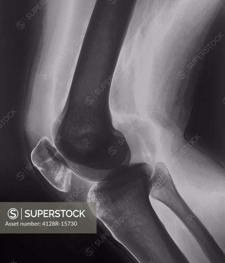 Broken knee. X_ray of the knee of a 38 year old patient with a fractured patella kneecap.