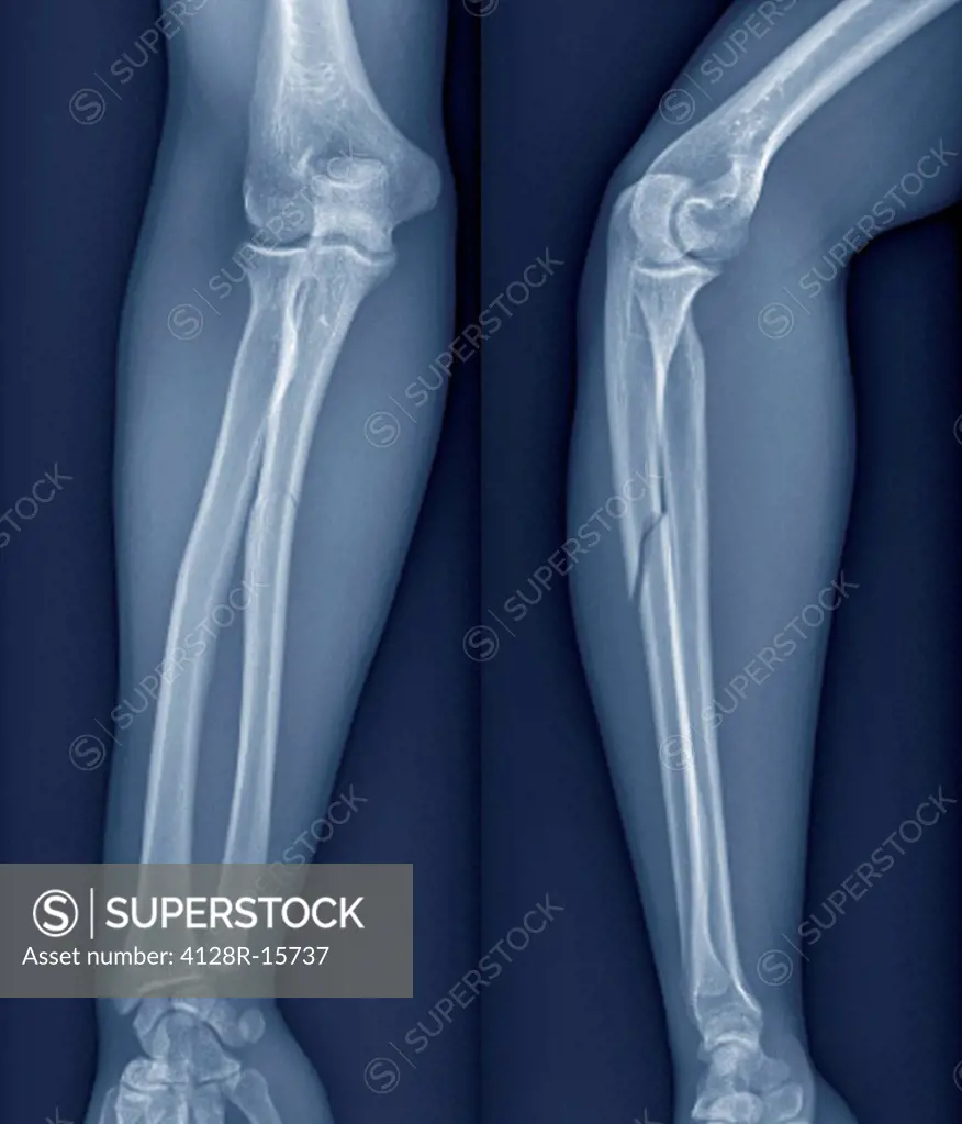 Broken arm. X_ray of the arm of a 20 year old patient with a fractured radius lower arm bone.