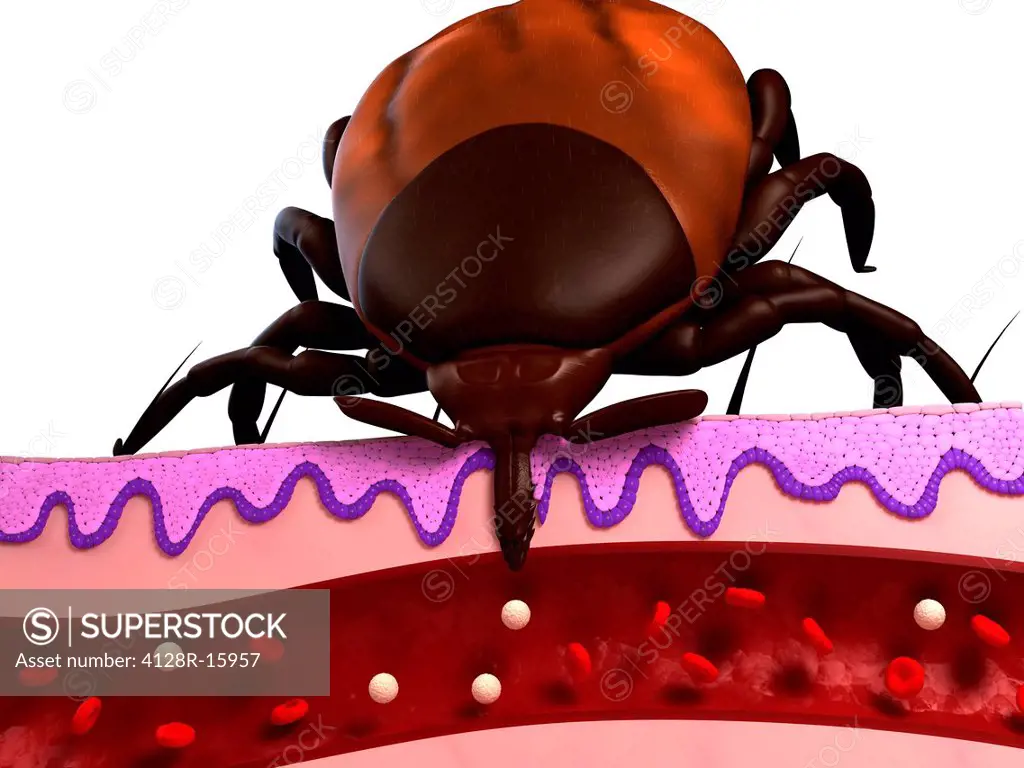 Tick feeding. Computer artwork of a tick superfamily Ixodoidea feeding, showing a cross_section through skin.