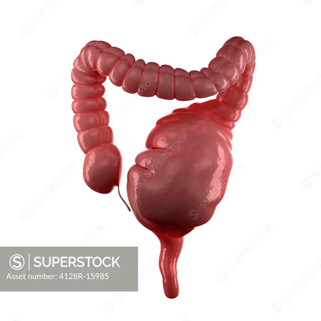 Megacolon, computer artwork. This is an abnormal dilation of the colon that may be congenital or acquired.