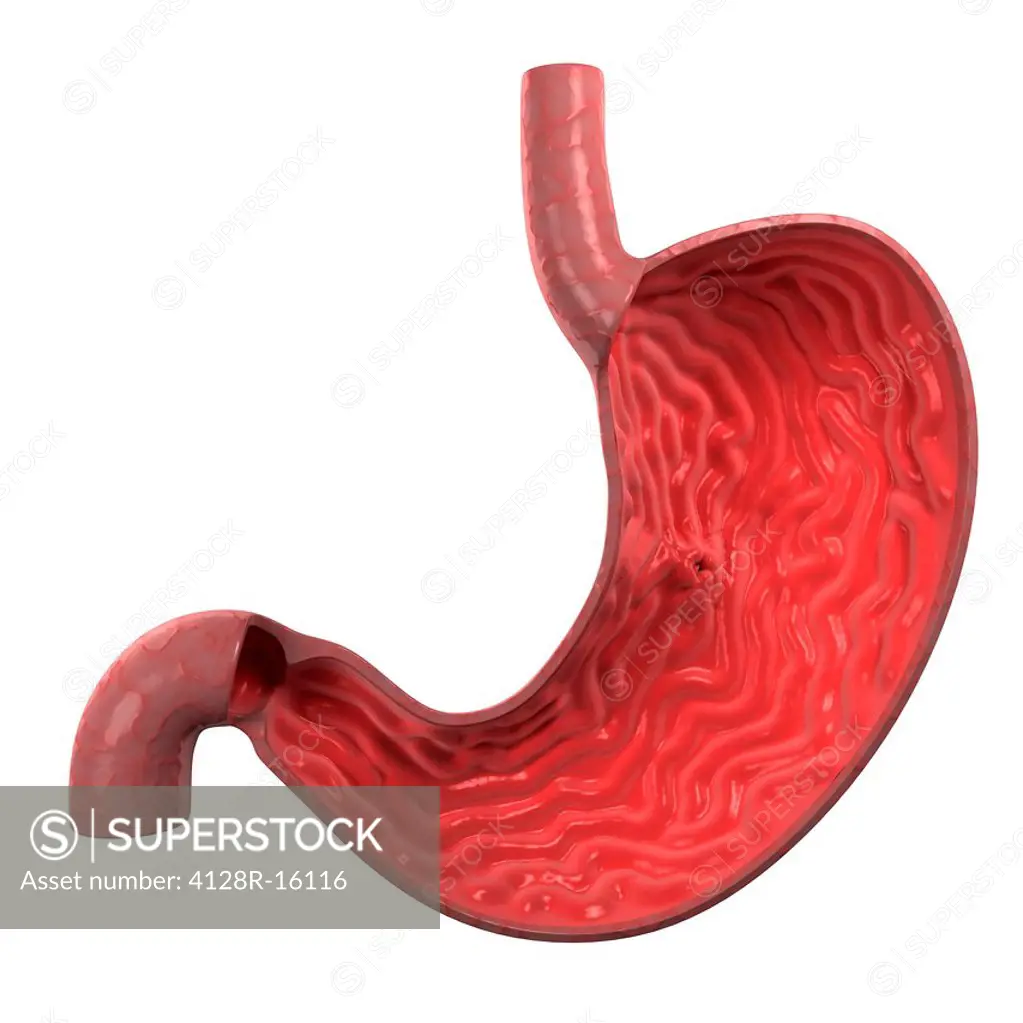 Stomach ulcer, computer artwork.