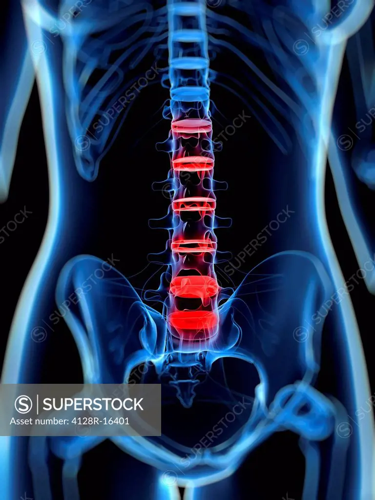 Back pain, conceptual computer artwork.