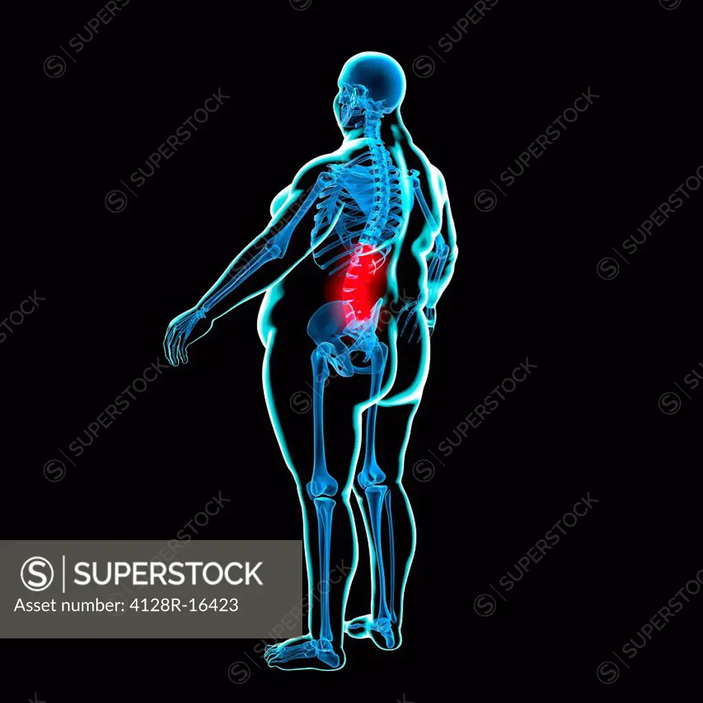 Back pain in obesity, conceptual computer artwork.