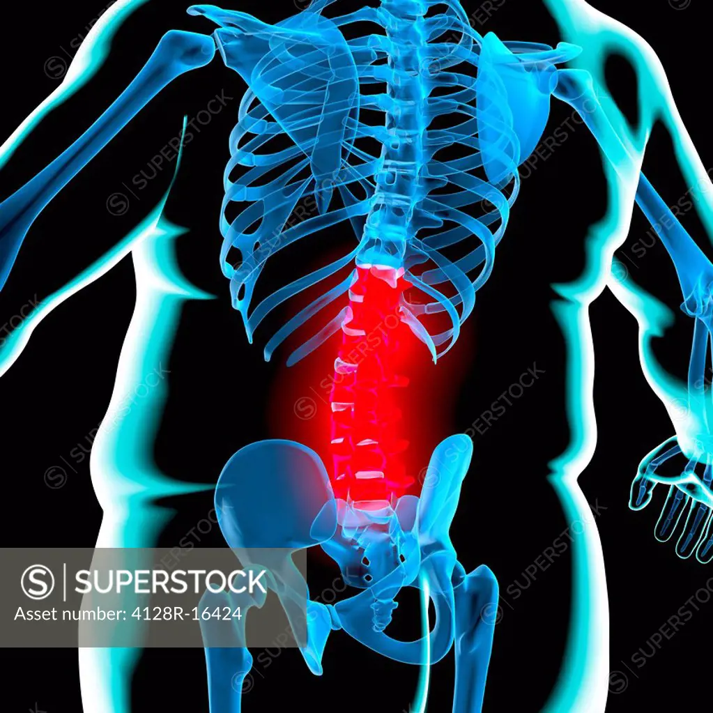 Back pain in obesity, conceptual computer artwork.