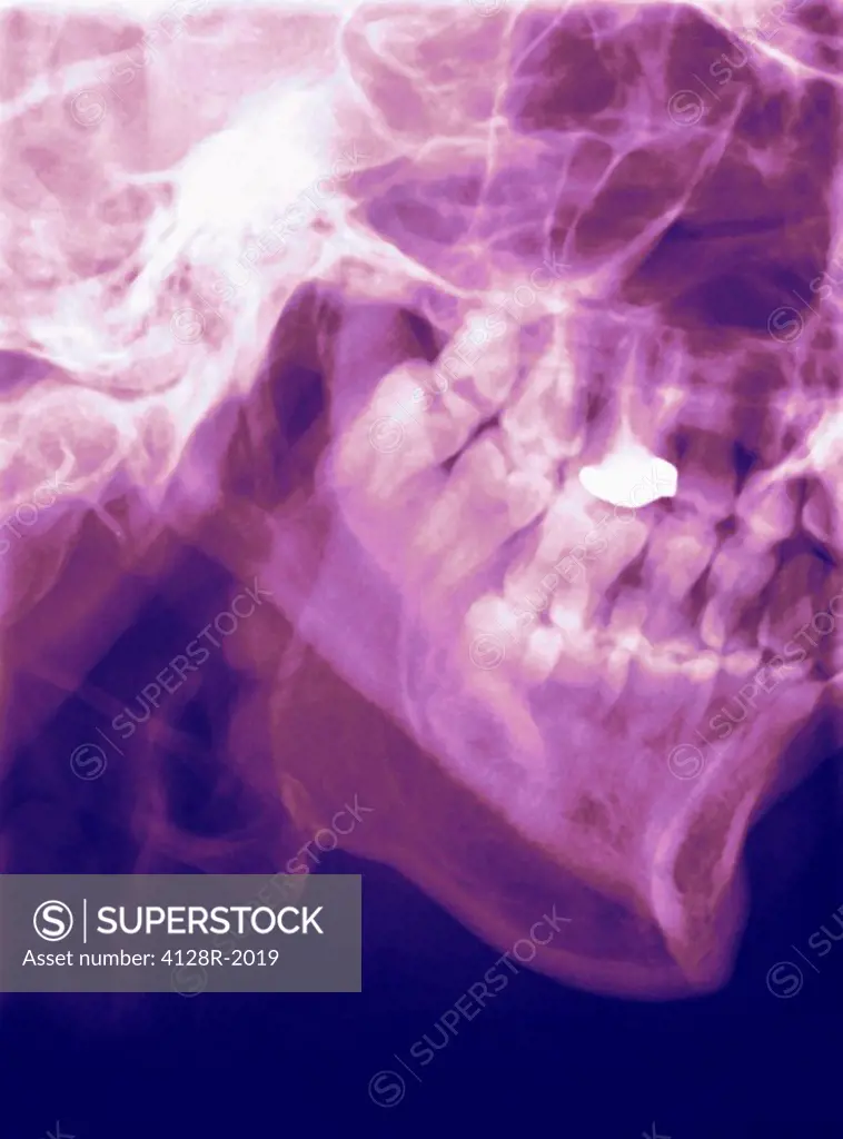 Normal lower jaw, X_ray