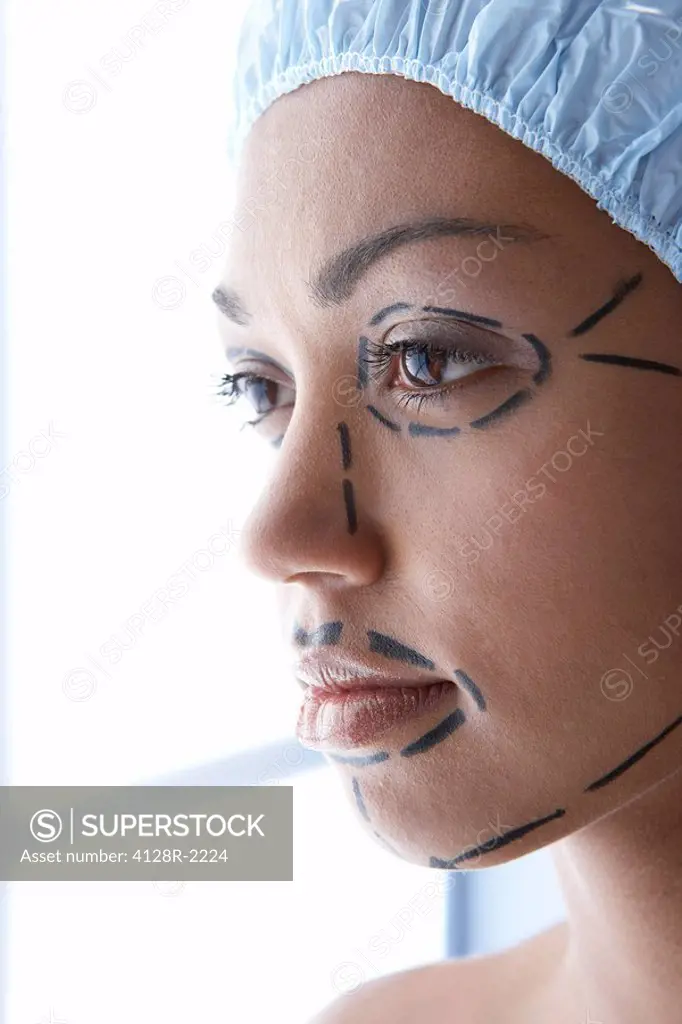 Facelift surgery markings