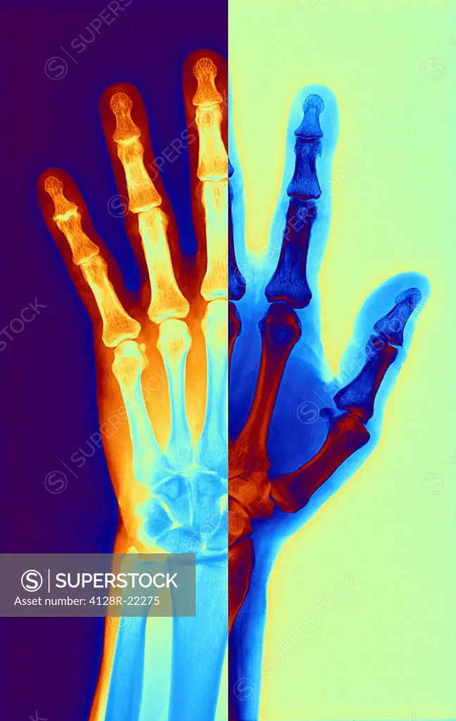 Computer_enhanced X_ray of the hand of a patient with osteoarthritis. Osteoarthritis is a degenerative disease that results in the loss of cartilage b...