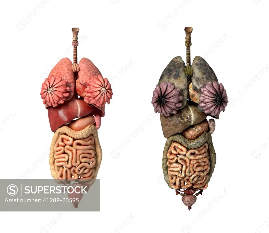 Healthy and diseased female organs, computer artwork.