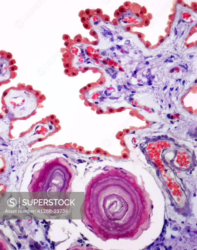 Corpora amylacea. Light micrograph of a section through the choroid plexus of brain, showing two corpora amylacea purple, bottom. These small masses a...