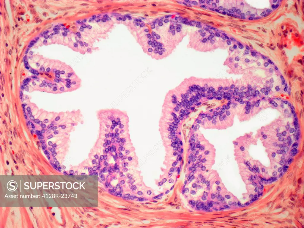 Graves´ disease. Light micrograph of a section through follicle from a thyroid gland affected by Grave´s disease. This is an autoimmune disease, where...